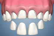 Upper Short Crowns and Open Bite Corrected with 4 Veneers